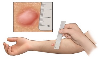 PPD (Pürified Protein Derivative) Testi (TCT)